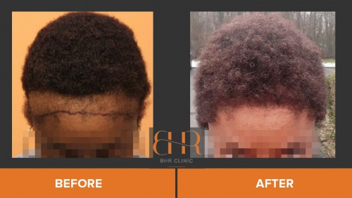 Results - BHR Clinic - Hair Transplant Surgery