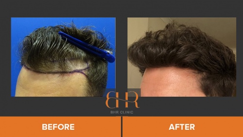 Results – BHR Clinic – Hair Transplant