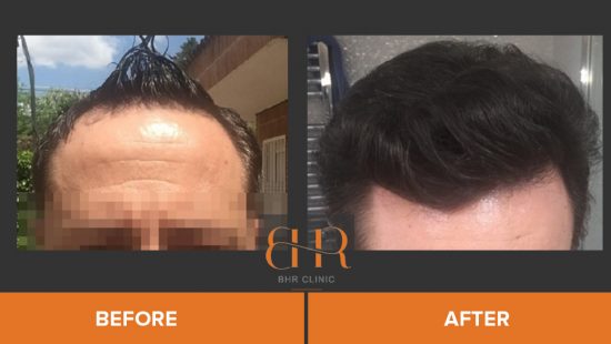 Hair Restoration Surgery Before and After