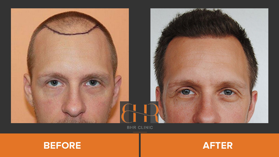Results – BHR Clinic – Hair Transplant