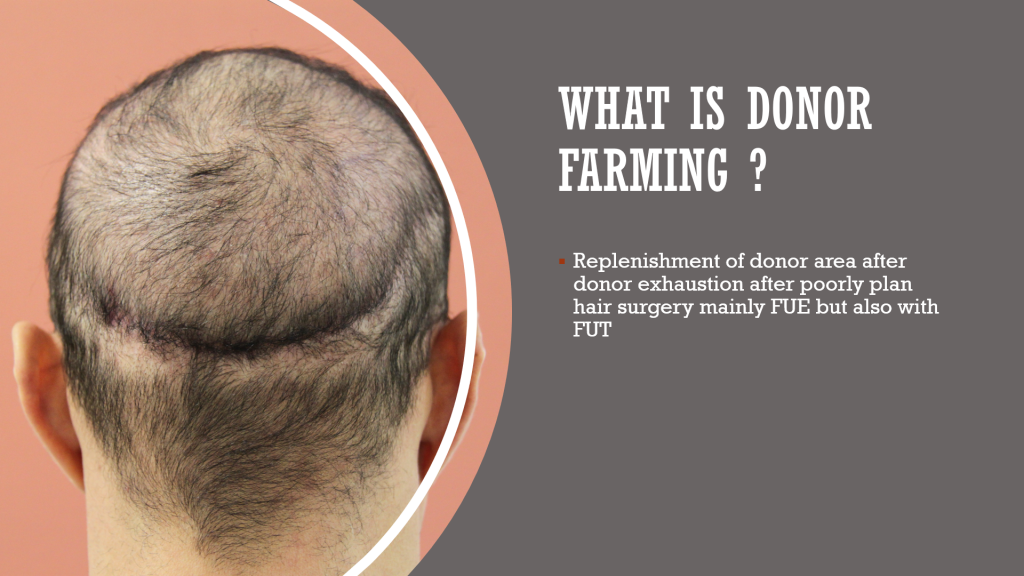 Donor Farming in FUE - Dr. Christian Bisanga