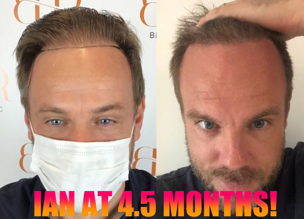 SUPER FAST GROWTH WITH FUE SURGERY! – BHR Clinic – Hair Transplant
