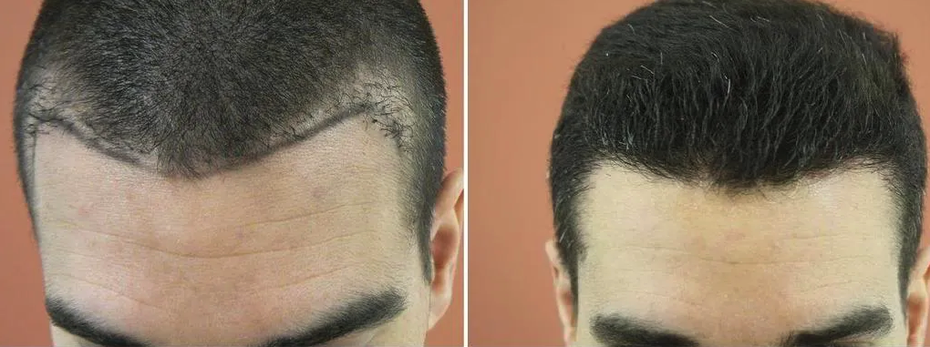Hair Transplant costs, the hidden dangers! We all have a budget, but what  should you look out for when searching for FUE surgery? Often with “cheap  deals”, you pay far more, not