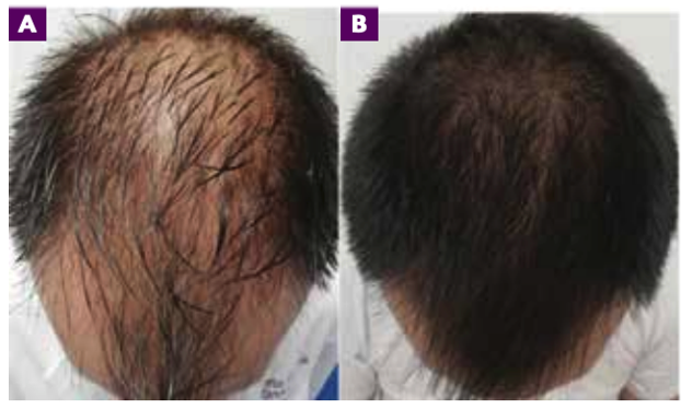 USE OF DUTASTERIDE IN MESOTHERAPY – BHR Clinic – Hair Transplant