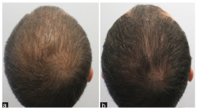 USE OF DUTASTERIDE IN MESOTHERAPY – BHR Clinic – Hair Transplant